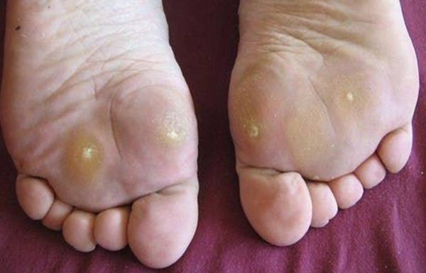 <center>Callus Spa Pedicure Cracked Heels