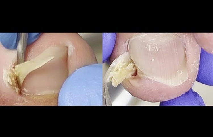 <center>Removal Ingrown Nail Pedicure