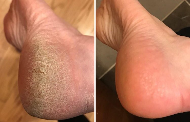 <center>Spa Pedicure For Crack Heels (Remove and repair thick and cracked feet and callus treatment)